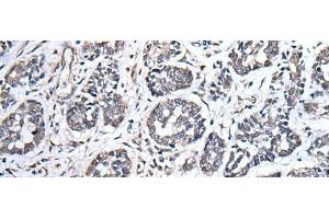 Immunohistochemistry of paraffin-embedded Human esophagus cancer tissue using UBE2E3 Polyclonal Antibody at dilution of 1:40(x200) (UBE2E3 antibody)