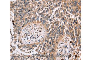 Immunohistochemistry of Human lung cancer using FUCA1 Polyclonal Antibody at dilution of 1:30 (FUCA1 antibody)