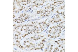 Immunohistochemistry of paraffin-embedded human colon carcinoma using SATB1 antibody. (SATB1 antibody)