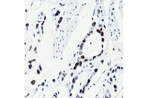 Immunohistochemistry of paraffin-embedded human gastric cancer using Acetyl-Histone H2B-K5 antibody (ABIN7267733) at dilution of 1:100 (40x lens). (Histone H2B antibody  (acLys5))