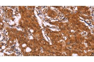 Immunohistochemistry of paraffin-embedded Human gastric cancer using APMAP Polyclonal Antibody at dilution of 1:30 (APMAP antibody)