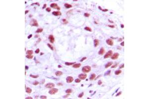 Immunohistochemical analysis of MCM4 staining in human breast cancer formalin fixed paraffin embedded tissue section. (MCM4 antibody  (N-Term))