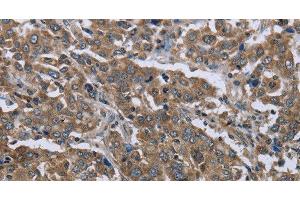 Immunohistochemistry of paraffin-embedded Human liver cancer using GGCX Polyclonal Antibody at dilution of 1:50 (GGCX antibody)