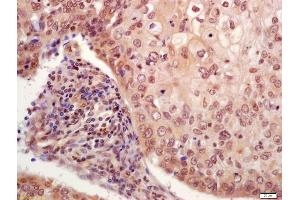 Formalin-fixed and paraffin embedded human laryngocarcinoma labeled with Anti-phospho-P53(Ser33) Polyclonal Antibody, Unconjugated (ABIN702925) at 1:200 followed by conjugation to the secondary antibody and DAB staining (p53 antibody  (pSer33))