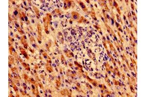 Immunohistochemistry of paraffin-embedded human liver cancer using ABIN7162762 at dilution of 1:100 (MTRF1 antibody  (AA 285-433))