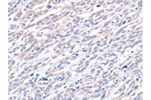 The image on the left is immunohistochemistry of paraffin-embedded Human esophagus cancer tissue using ABIN7128194(ACTL8 Antibody) at dilution 1/15, on the right is treated with fusion protein. (Actin-Like 8 antibody)