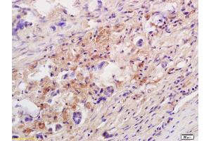 Formalin-fixed and paraffin embedded human colon carcinoma labeled with Anti-IL-10 Polyclonal Antibody, Unconjugated (ABIN872478) at 1:200 followed by conjugation to the secondary antibody and DAB staining. (IL-10 antibody  (AA 101-178))