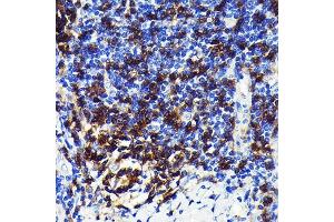 Immunohistochemistry of paraffin-embedded human lung cancer using CD4 Rabbit mAb (ABIN7266195) at dilution of 1:100 (40x lens). (CD4 antibody)