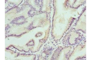 Immunohistochemistry of paraffin-embedded human prostate cancer using ABIN7157212 at dilution of 1:100 (Kallikrein 4 antibody  (AA 30-254))