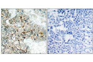 Immunohistochemical analysis of paraffin-embedded human breast carcinoma tissue using Integrin b3(Phospho-Tyr773) Antibody(left) or the same antibody preincubated with blocking peptide(right). (Integrin beta 3 antibody  (pTyr773))