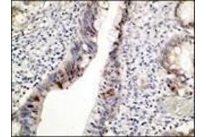 Immunohistochemistry (IHC) image for anti-Tumor Protein P53 (TP53) (N-Term) antibody (ABIN870345) (p53 antibody  (N-Term))