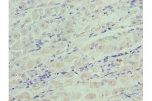 Immunohistochemistry of paraffin-embedded human gastric cancer using ABIN7156368 at dilution of 1:100 (IGFBPI antibody  (AA 26-259))