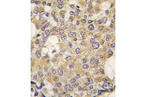 Formalin-fixed and paraffin-embedded human breast carcinoma tissue reacted with Parg antibody , which was peroxidase-conjugated to the secondary antibody, followed by DAB staining. (PARG antibody  (C-Term))