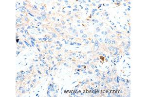 Immunohistochemistry of Human esophagus cancer using P2RY1 Polyclonal Antibody at dilution of 1:50 (P2RY1 antibody)