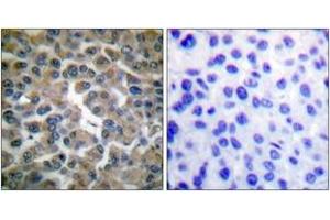 Immunohistochemistry analysis of paraffin-embedded human breast carcinoma tissue, using IkappaB-epsilon (Ab-22) Antibody. (IkappaB-epsilon antibody  (AA 131-180))