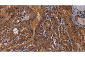 Immunohistochemistry of paraffin-embedded Human thyroid cancer tissue using MAGEB10 Polyclonal Antibody at dilution 1:60 (MAGEB10 antibody)