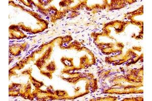 Immunohistochemistry of paraffin-embedded human prostate tissue using ABIN7154296 at dilution of 1:100 (GOLPH3 antibody  (AA 16-150))