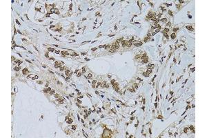 Immunohistochemistry of paraffin-embedded human gastric cancer using EMD antibody. (Emerin antibody)