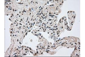 Immunohistochemical staining of paraffin-embedded Adenocarcinoma of breast tissue using anti-FERMT2 mouse monoclonal antibody. (FERMT2 antibody)