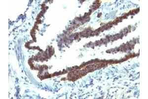 Immunohistochemistry (Formalin-fixed Paraffin-embedded Sections) (IHC (fp)) image for anti-Epithelial Cell Adhesion Molecule (EPCAM) (Cytoplasmic Domain) antibody (ABIN3024725)