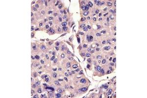 (ABIN6242256 and ABIN6578832) staining CANX in human hepatocarcinoma sections by Immunohistochemistry (IHC-P - paraformaldehyde-fixed, paraffin-embedded sections). (Calnexin antibody  (AA 560-592))