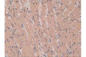 IHC-P analysis of Human Stomach Cancer Tissue, with DAB staining. (Smooth Muscle Actin antibody  (AA 167-377))