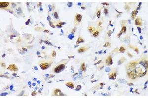 Immunohistochemistry of paraffin-embedded Human lung cancer using EP300 Polyclonal Antibody at dilution of 1:100 (40x lens). (p300 antibody)