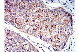 Immunohistochemical analysis of paraffin-embedded bladder cancer tissues using P2RY1 mouse mAb with DAB staining. (P2RY1 antibody)