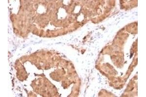 Formalin-fixed, paraffin-embedded human prostate carcinoma stained with Glyoxalase 1 (GLO1) Mouse Monoclonal Antibody (CPTC-GLO1-1). (GLO1 antibody)