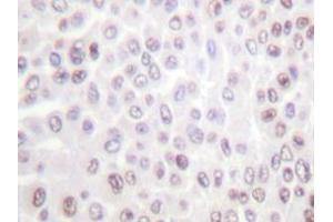 Immunohistochemistry analyzes of Histone H2B antibody in paraffin-embedded human breast carcinoma tissue. (Histone H2B antibody)