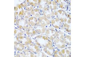 Immunohistochemistry of paraffin-embedded human stomach cancer using ANKRD52 antibody (ABIN5974842) at dilution of 1/100 (40x lens). (ANKRD52 antibody)