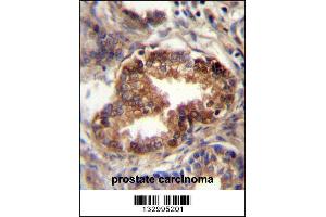 RAB3D Antibody immunohistochemistry analysis in formalin fixed and paraffin embedded human prostate carcinoma followed by peroxidase conjugation of the secondary antibody and DAB staining. (RAB3D antibody  (C-Term))