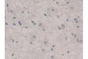 DAB staining on IHC-P; Samples: Human Glioma Tissue (Nestin antibody  (AA 178-399))