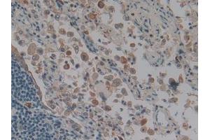 IHC-P analysis of Human Lung cancer Tissue, with DAB staining. (Keratin 3 antibody  (AA 198-514))