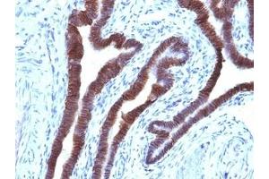 Immunohistochemistry (Formalin-fixed Paraffin-embedded Sections) (IHC (fp)) image for anti-Epithelial Cell Adhesion Molecule (EPCAM) (Cytoplasmic Domain) antibody (ABIN3024725)