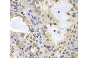 Immunohistochemistry of paraffin-embedded Human oophoroma using MCM3 Polyclonal Antibody at dilution of 1:100 (40x lens). (MCM3 antibody)