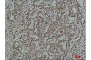 Immunohistochemistry (IHC) analysis of paraffin-embedded Human Breast Carcinoma using Stat3 Polyclonal Antibody. (STAT3 antibody)