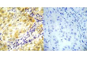 Immunohistochemical analysis of paraffin- embedded human lung carcinoma tissue using P53 (Ab-37) antibody (E022031). (p53 antibody)