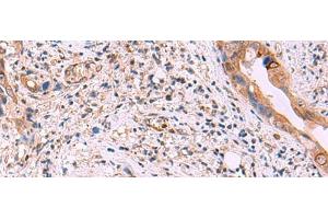 Immunohistochemistry of paraffin-embedded Human cervical cancer tissue using ZAP70 Polyclonal Antibody at dilution of 1:55(x200) (ZAP70 antibody)