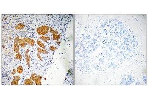 Immunohistochemistry analysis of paraffin-embedded human breast carcinoma tissue, using CKLF4 antibody. (CKLF antibody  (Internal Region))