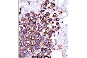 Formalin-fixed and paraffin-embedded human cancer tissue reacted with the primary antibody, which was peroxidase-conjugated to the secondary antibody, followed by DAB staining. (CAMK1 antibody  (C-Term))