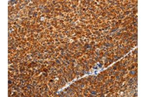 The image on the left is immunohistochemistry of paraffin-embedded Human liver cancer tissue using ABIN7131154(SPATA13 Antibody) at dilution 1/20, on the right is treated with fusion protein. (SPATA13 antibody)