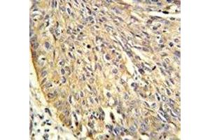 Annexin A1 antibody IHC analysis in formalin fixed and paraffin embedded human lung carcinoma. (Annexin a1 antibody  (AA 129-158))