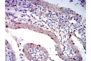 Immunohistochemical analysis of paraffin-embedded endometrial cancer tissues using BAX mouse mAb with DAB staining. (BAX antibody  (AA 13-160))