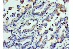 Immunohistochemistry of paraffin-embedded human lung cancer using ABIN7147858 at dilution of 1:100 (CLTA antibody  (AA 1-218))