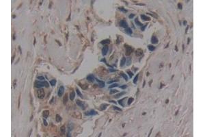 Detection of GLG1 in Human Breast cancer Tissue using Polyclonal Antibody to Golgi Glycoprotein 1 (GLG1) (GLG1 antibody  (AA 1048-1145))