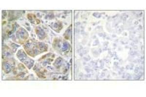 Immunohistochemistry analysis of paraffin-embedded human breast carcinoma tissue using ITGB4 (Ab-1510) antibody. (Integrin beta 4 antibody  (Tyr1510))