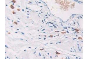 DAB staining on IHC-P; Samples: Human Colorectal cancer Tissue (CEACAM7 antibody  (AA 147-231))