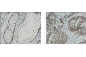 Immunohistochemical staining of  normal colon (left) and colon carninoma (center) using hnRNP-K antibody . (HNRNPK antibody  (C-Term))