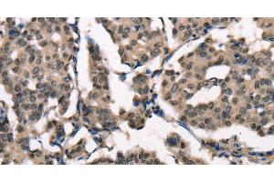 Immunohistochemistry of paraffin-embedded Human breast cancer using NSMCE3 Polyclonal Antibody at dilution of 1:40 (Necdin-Like 2 antibody)